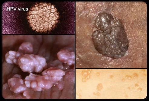 Genital Warts